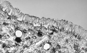 celiakia celiakia